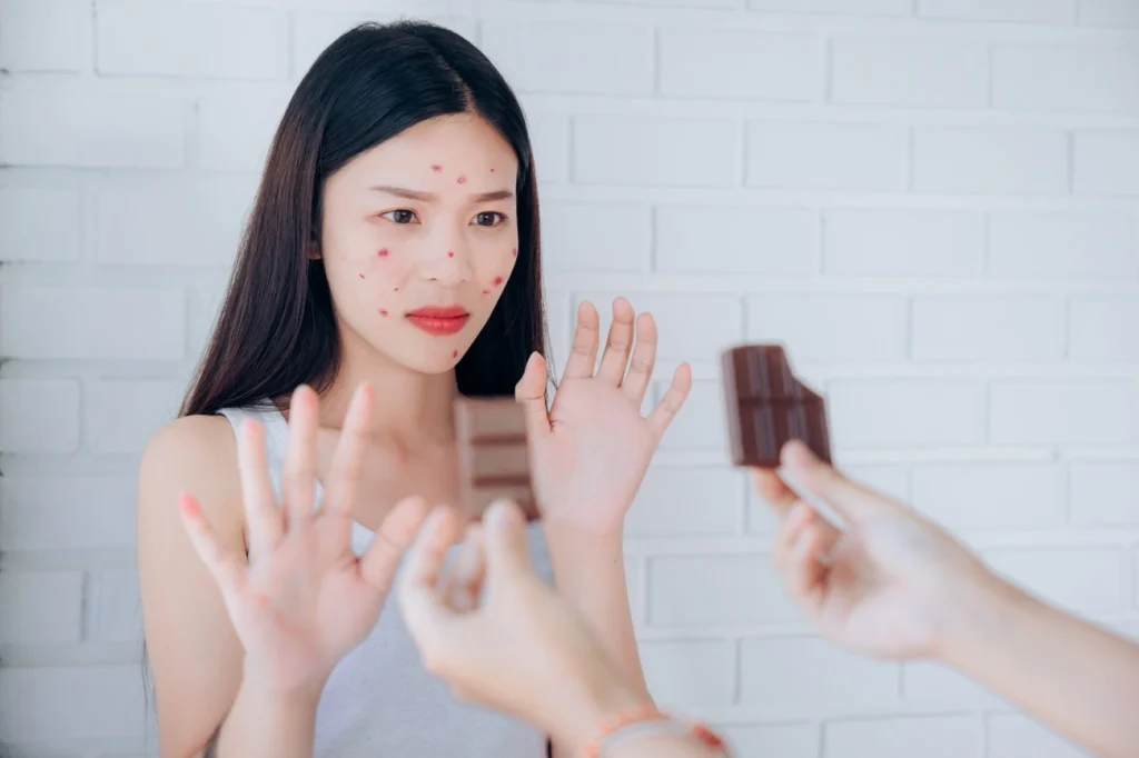 Chocolate causa espinha? Dermatologista dá o seu veredito