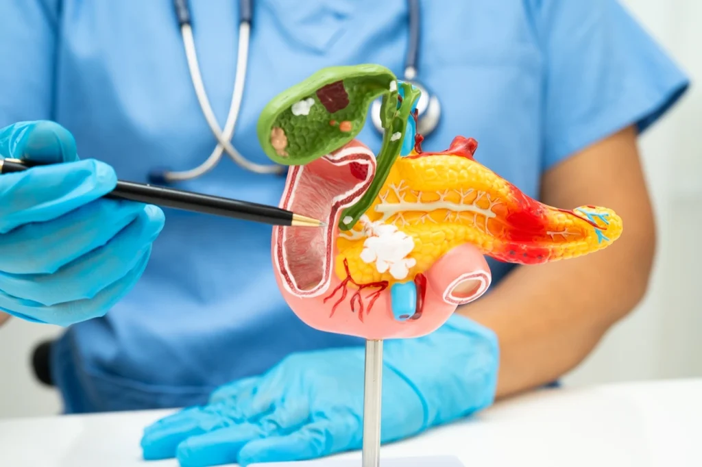 Diabetes repentina após os 50 anos pode sinalizar câncer de pâncreas Diabetes repentina após os 50 anos pode sinalizar câncer de pâncreas