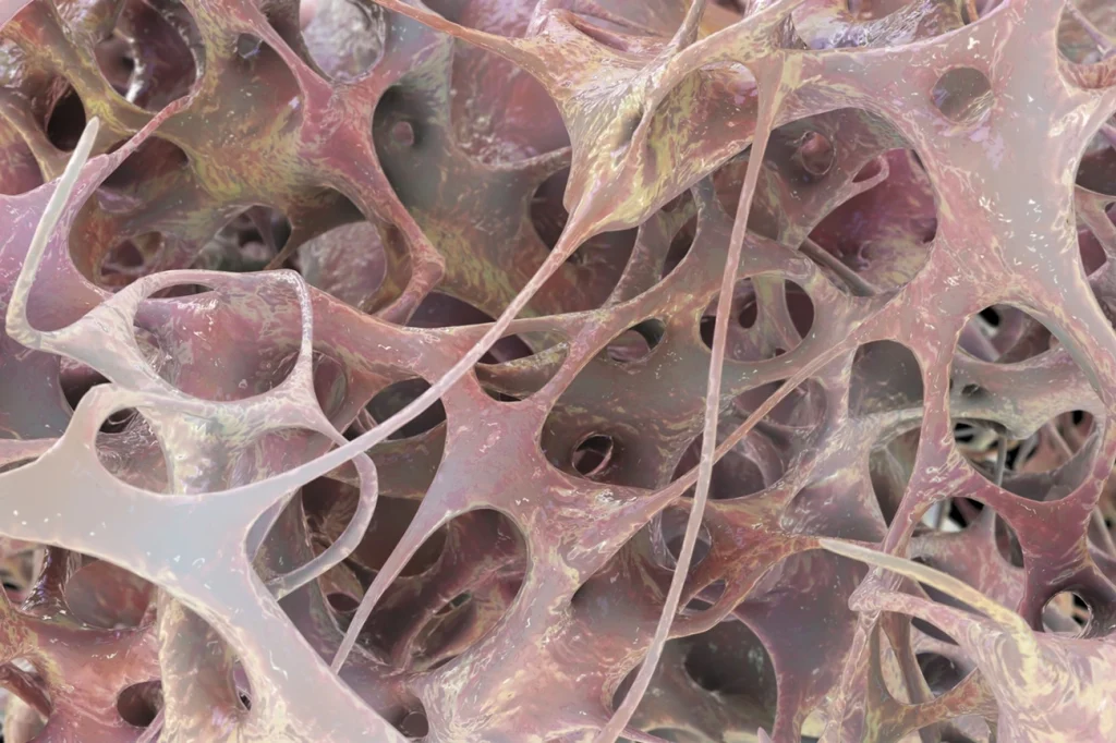 Descubra agora os 7 sintomas de osteoporose segundo ortopedistas e fisiatras