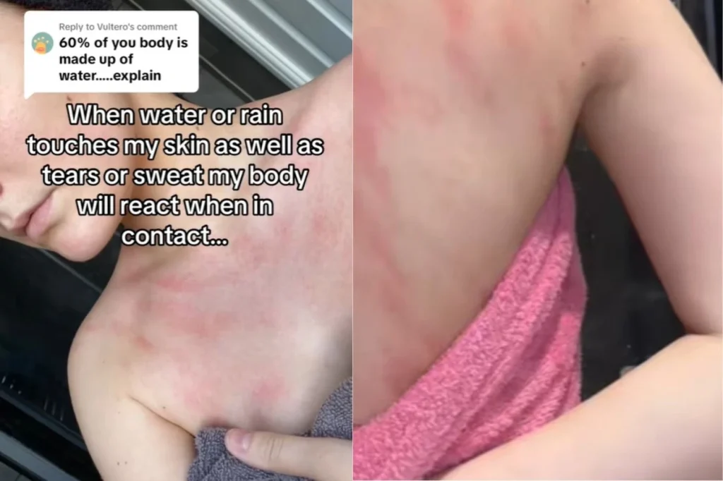 Chelsea sofre com alergia grave à água: descubra como ela lida com a urticária aquagênica